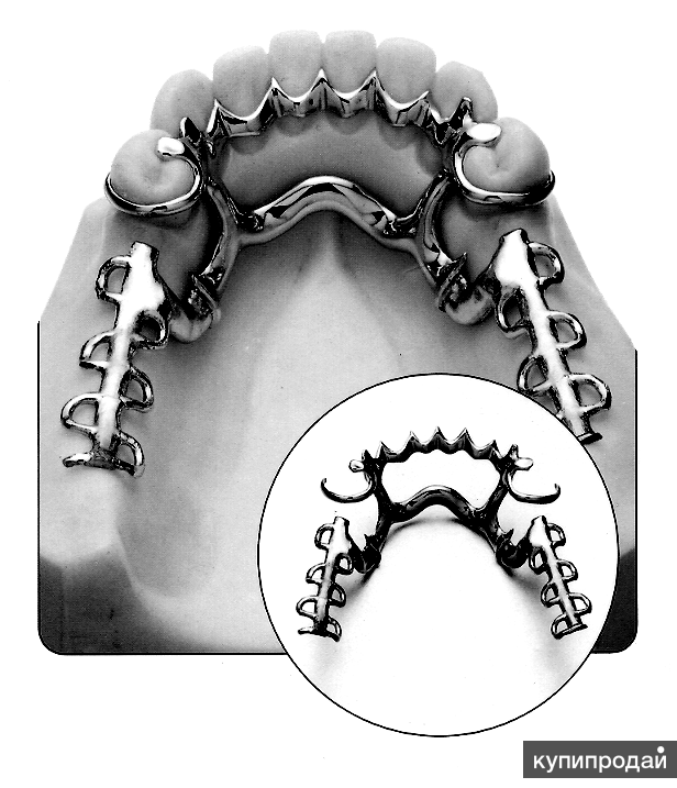 Дробители нагрузки бюгельного протеза. Каркас бюгельного протеза на нижнюю челюсть. Кольцевая дуга бюгельного протеза. Дуга бюгельного протеза на нижней челюсти. Многозвеньевой бюгельный протез.