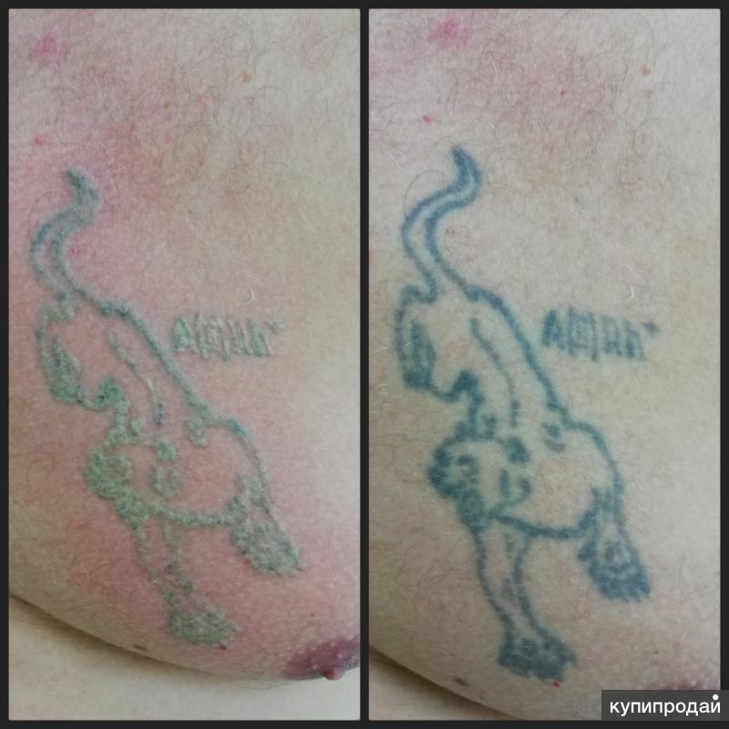 Чешется после тату. Сведение тату до и после. Лазерное удаление тату. Лазерное удаление тату до и после.